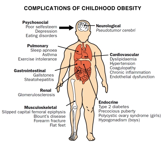 Complications With Childhood Obesity 